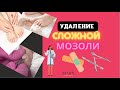 Удаление сложной мозоли. Один из способов избавиться от мозоли. Как удалить мозоль