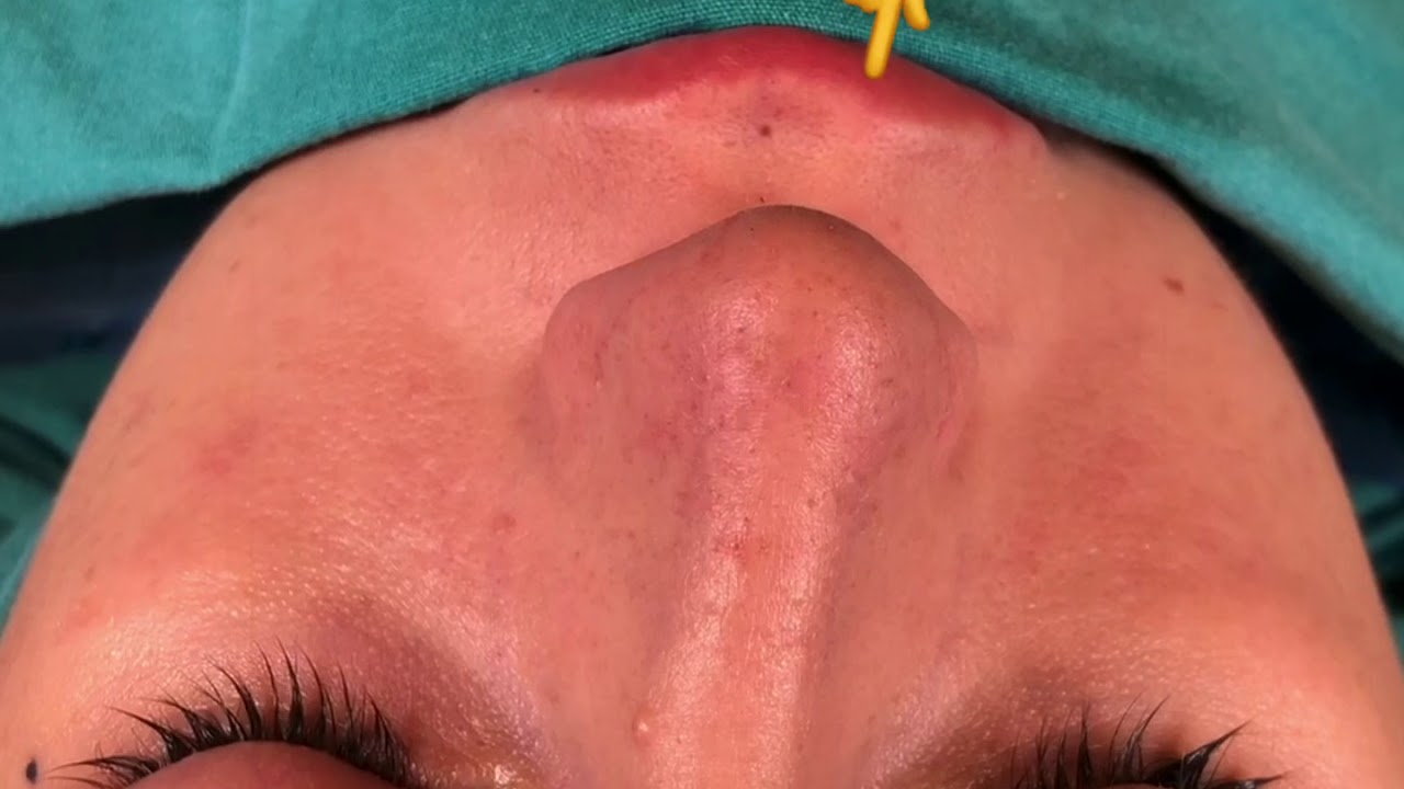Correction of a Severly Crooked Nose by Closed Atraumatic Rhinoplasty - YouTube
