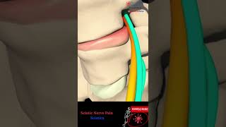 عرق النسا - Sciatic nerve ️