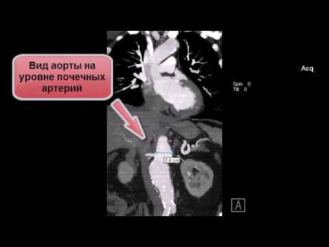 КТ грудной клетки аневризма грудной аорты ТАА 3 типа