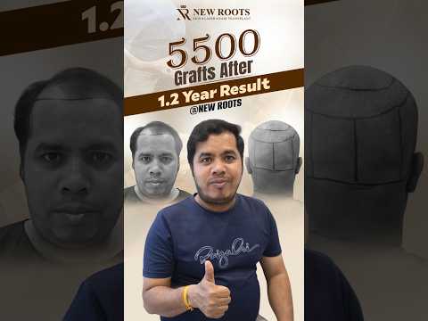 Hair Transplant in Nagpur: 5500 Grafts | Cost and Best Results #hair #viral #shorts