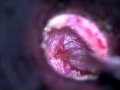 Tube surgery micro straight forceps
