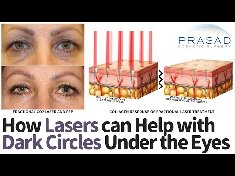 How Under Eye Dark Circles can be Treated with Lasers, Plus other Treatments