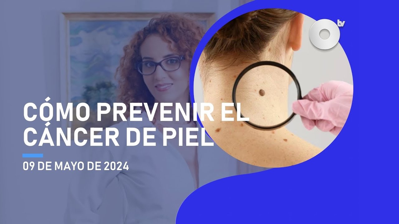 NoticiasEcuador El cáncer de piel cómo detectarlo a tiempo YouTube