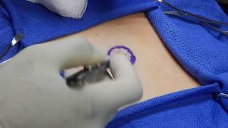 Umbilicoplasty Procedure Video--Malik Kutty, MD--Luxe Plastic Surgery--Houston, TX Umbilicoplasty Procedure Video--Malik Kutty, MD--Luxe Plastic Surgery--Houston, TX
