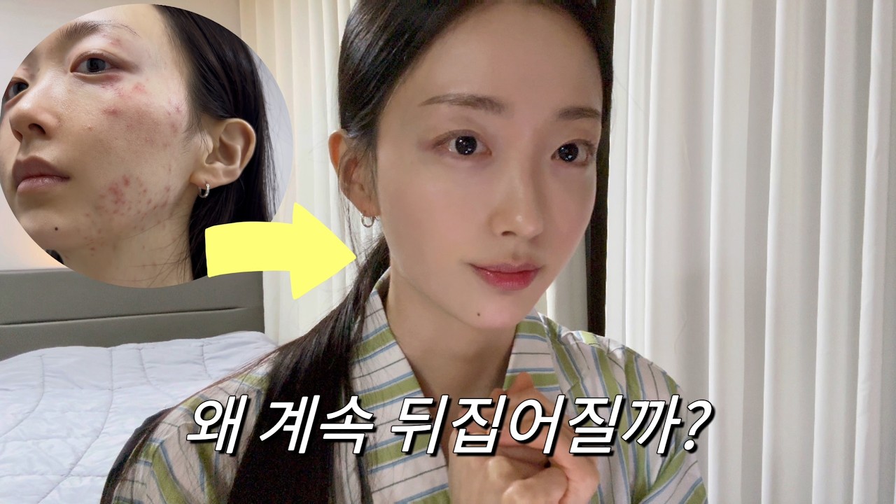 피부 계속 뒤집어지면 이것부터 의심하세요 