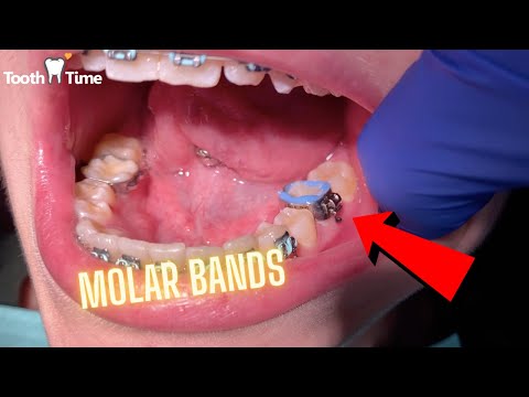 Braces on - getting Molar Bands - Tooth Time Family Dentistry New Braunfels Texas