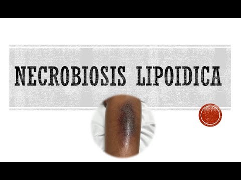 Necrobiosis Lipoidica