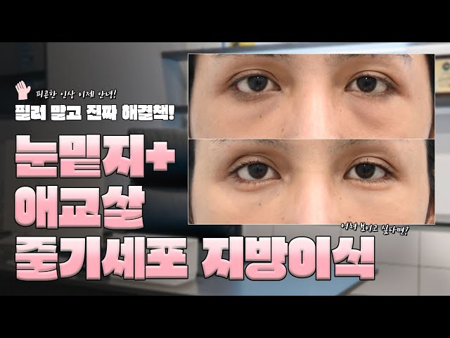 필러 말고 진짜 해결책! 눈밑지방재배치+ 애교살 줄기세포 지방이식