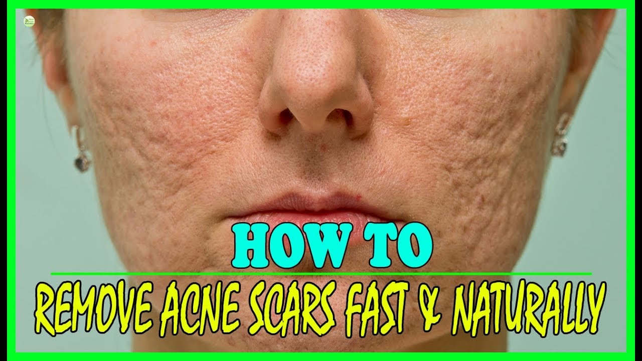 4 Natural Remedies That Remove Acne Scars Fast How To Get Rid Of Acne