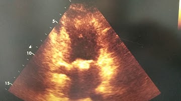 Caseous calcification of the mitral ring ,an ignored entity