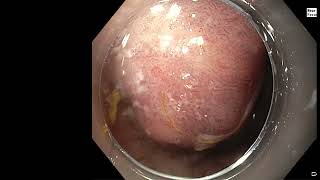 3 months of follow after ESD in the anus and rectum