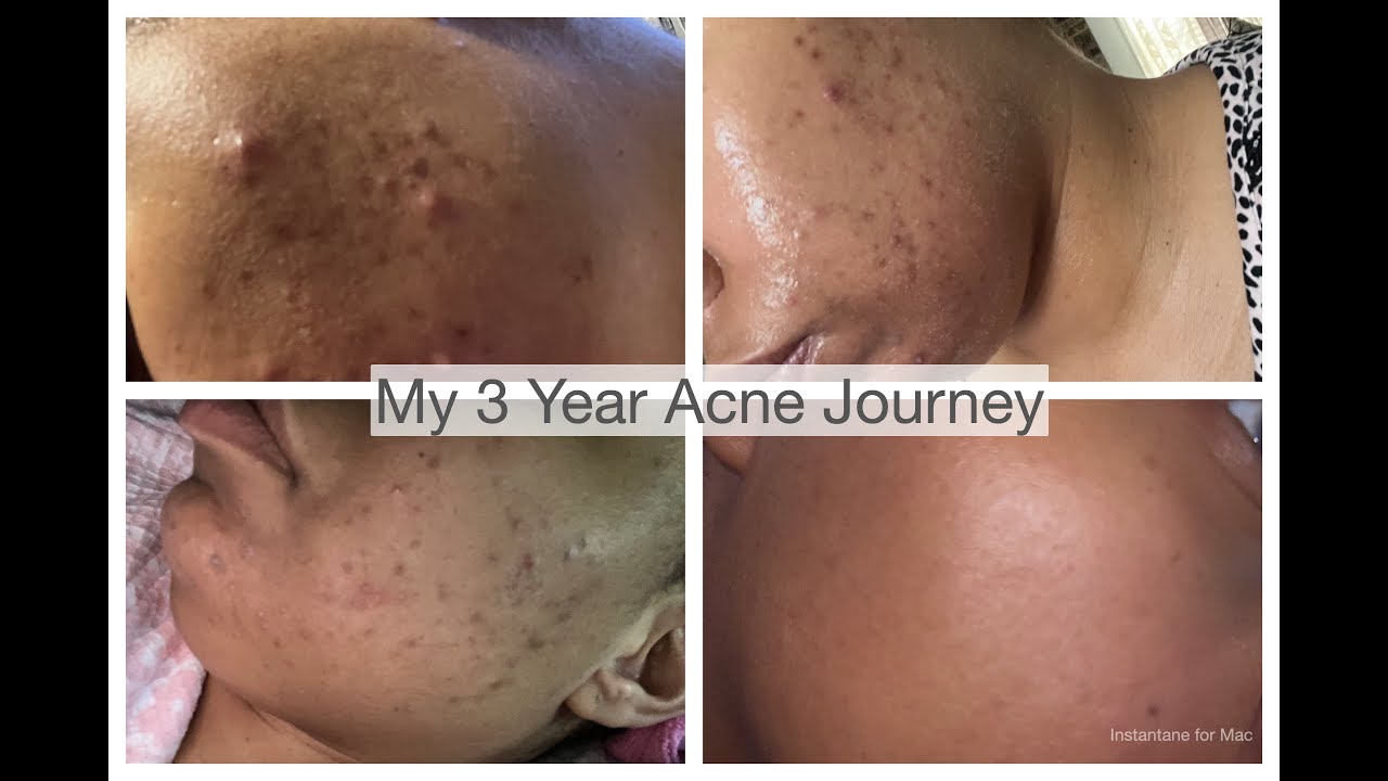 My 3 year acne journey.. How I cleared my Acne in 3 months. - YouTube