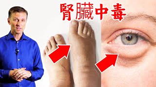 腎臟中毒7個警訊,腎結石不能吃什麼?柏格醫生 Dr Berg