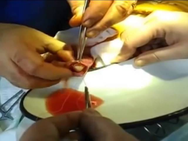 Болезни почек, симптомы и лечение.