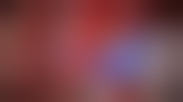 Left A3 ACA – Right A3 ACA In Situ Bypass and Distal Clipping of a Dolichoectatic A2 ACA Aneurysm