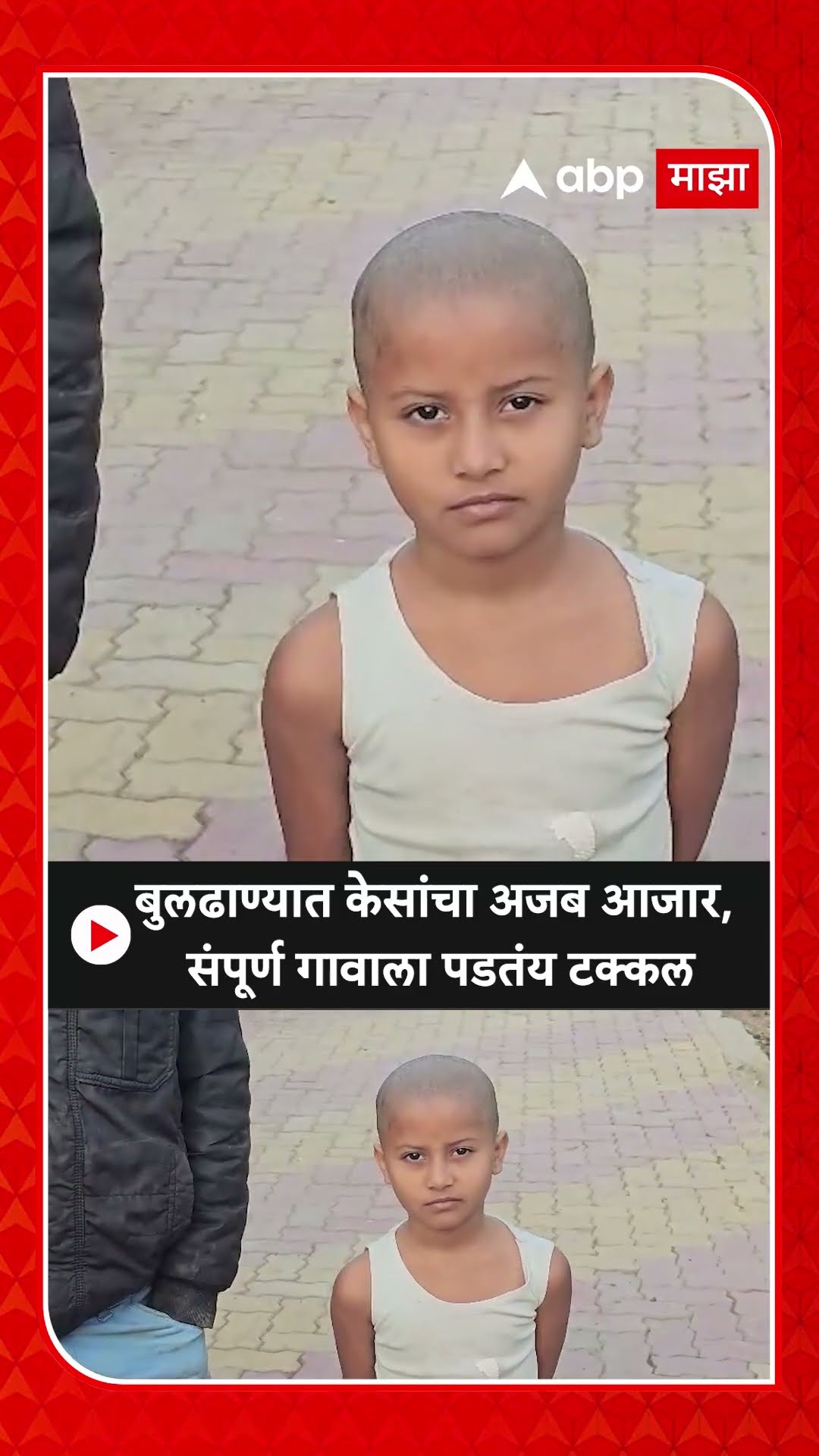 Buldhana Hair Loss Story : बुलढाण्यात अजब आजार, गावातील प्रत्येकाला तीन दिवसात पडतंय टक्कल