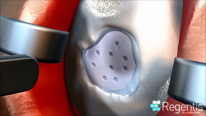 GelrinC Implant | Procedure Animation | Articular Cartilage Repair | Regentis Biomaterials