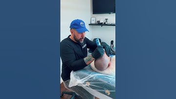 Session 1 Scalp Micropigmentation #SMP