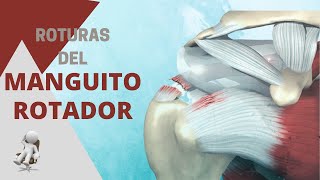 ROTURA DEL MANGUITO ROTADOR ¿Qué dice la CIENCIA?