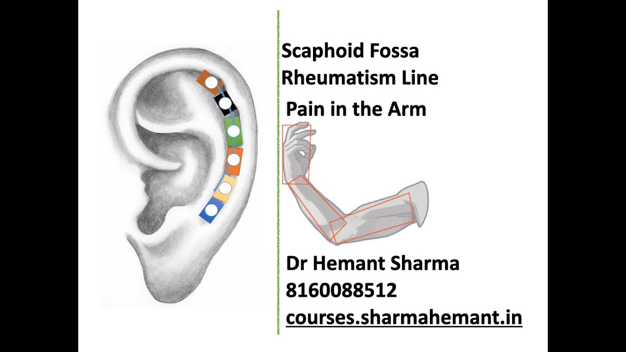 Feb Auricular Therapy Scaphoid Fossa Rheumatism Line The Pain Of Shoulder Arm Insomnia