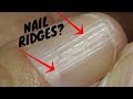 What Causes Horizontal Ridges on Nails With Karen Langston