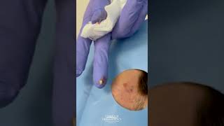 Pesky Little Forehead Pimple Popped By Dermatologist Contour Dermatology