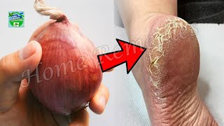 Remove Cracked Heels and Get Soft Feet Permanently || Magical Cracked Heels Home Remedy screenshot 1