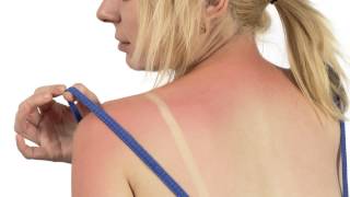 Ask the Expert - Dr. Erin Brennan of Sinai-Grace Hospital - What is Melanoma?