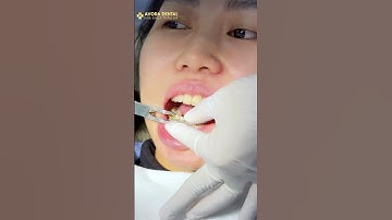 Tháo niềng thôi!!! #shorts #shortvideo #video #kamy