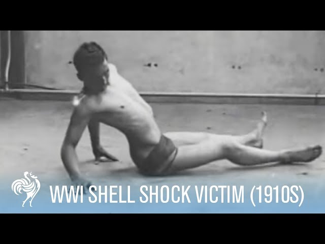 Hypnotism used to treat shell shock victims