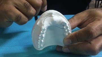 Max Class IV acrylic RPD designing on cast