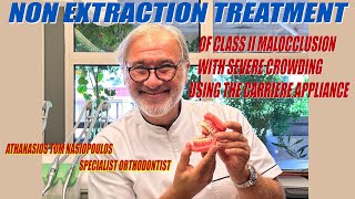 Non Extraction Treatment of Class II Malocclusion with Severe Crowding using Carriere