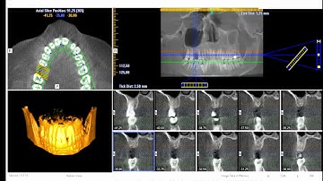 Aquisição da TCFC - Manuseio do software