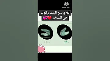 الاختلاف بين الجنين الذكر والجنين الانثى بالسونار 