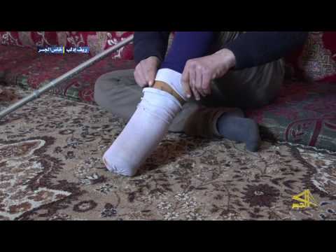 بسمة ألم بترت ساقه بمعارك مع النظام وكله تفاؤل بمستقبل أفضل 