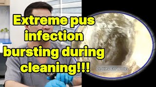Extreme pus infection bursting during cleaning | ear cleaning | ASMR earwax | soothing |relax|