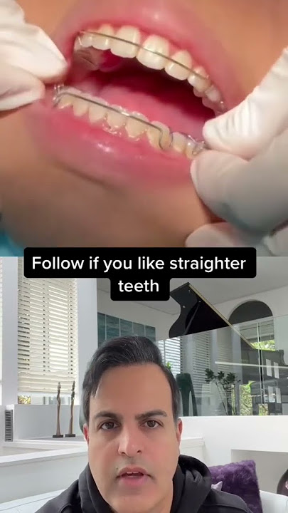 Lakukan ini agar gigimu tetap rapi!🥰#Gigi #KawatKawat #Ortopedi #DokterGigiOrtodontis #Invisalign