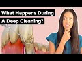 What Happens During a Deep Cleaning Procedure (Scaling and Root Planing)