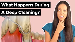 What Happens During a Deep Cleaning Procedure (Scaling and Root Planing)