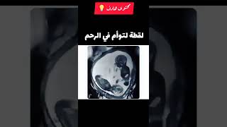 هكذا يبدو شكل التوأم في الرحم | لقطة رائعة لتوأم في الرحم 💡🤝🤰👶