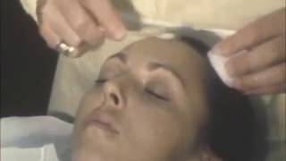 Chemabrasion performed by Dermatologist Wm. Elstein, MD PA