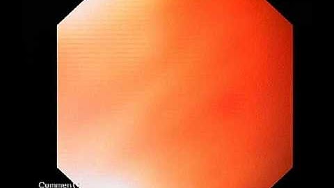 Diffuse oesophageal spasm