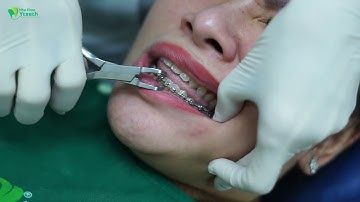 Tháo Niềng Mắc Cài Kim Loại và Cảm Nhận Có 102 || Bác sĩ Yến Yteeth