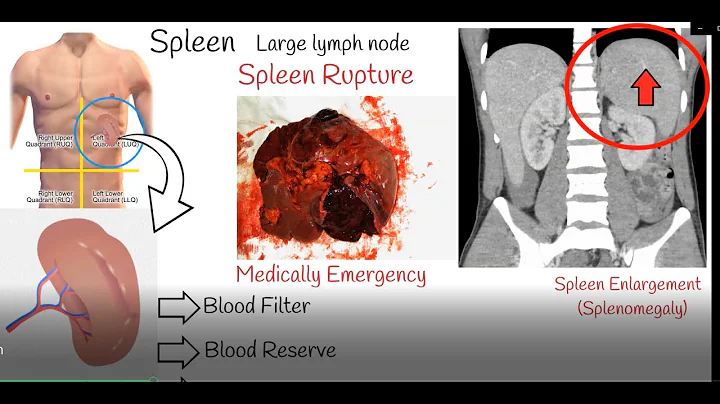 Spleen pain, Spleen enlargement and Spleen rupture. Causes and treatment - DayDayNews