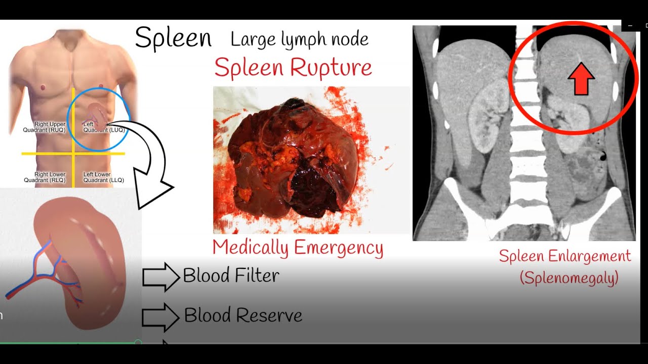 Ruptured Spleen Symptoms