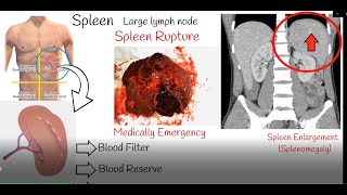 Spleen pain, Spleen enlargement and Spleen rupture. Causes and treatment