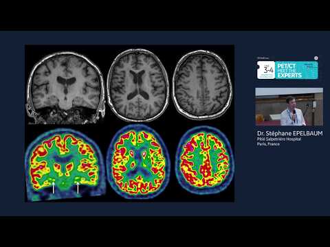 Vidéo: Brain PET Scan: Objectif, Procédure Et Risques