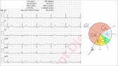 Ekg Befundung Herzfrequenz In Sekunden Bestimmen 300 150 100 Methode Youtube