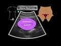 POCUS Female Pelvis Transabdominal scanning sequence